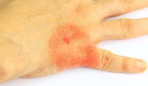 Как смыть йод с кожи? 7 способов, рекомендации по очищению, видео